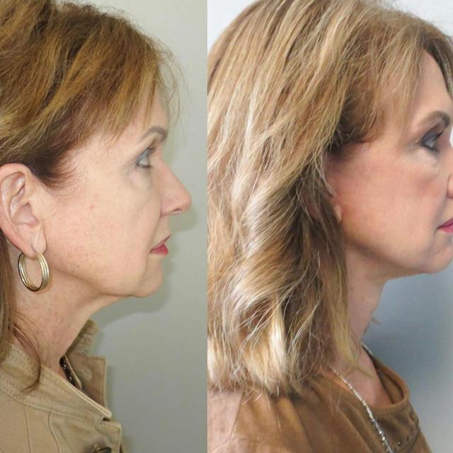 Facelift after at Dr. Courtney in Houston, TX