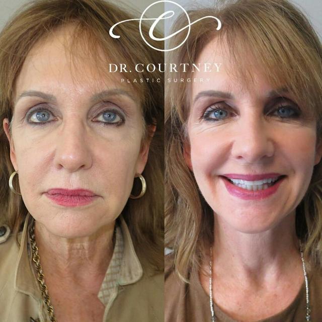 Facelift before at Dr. Courtney in Houston, TX