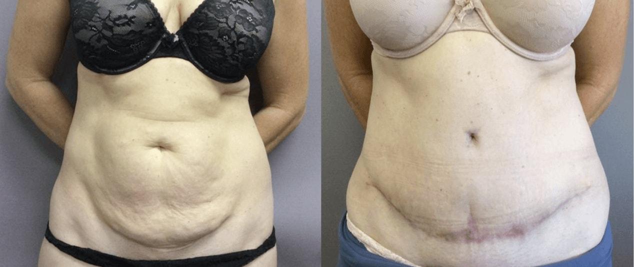 eSSe Plastic Surgery tummy tuck result — Fort Lauderdale, FL