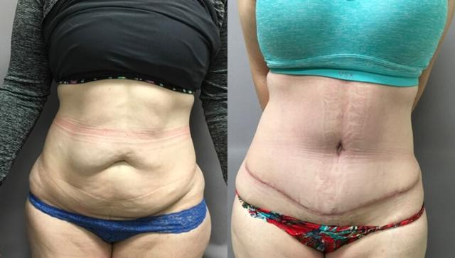 Mommy Makeover result at eSSe Plastic Surgery in Fort Lauderdale, FL