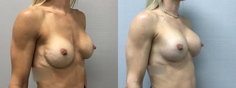eSSe Plastic Surgery breast augmentation result — Fort Lauderdale, FL