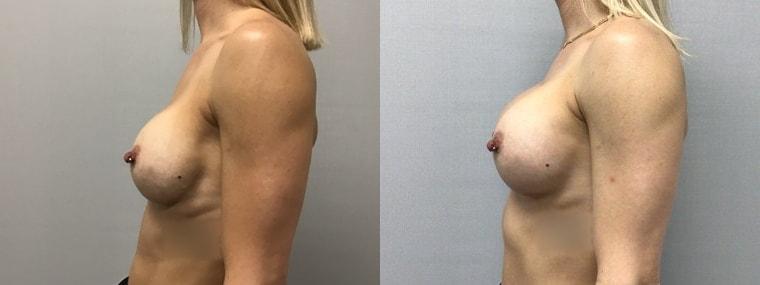 eSSe Plastic Surgery breast augmentation result — Fort Lauderdale, FL
