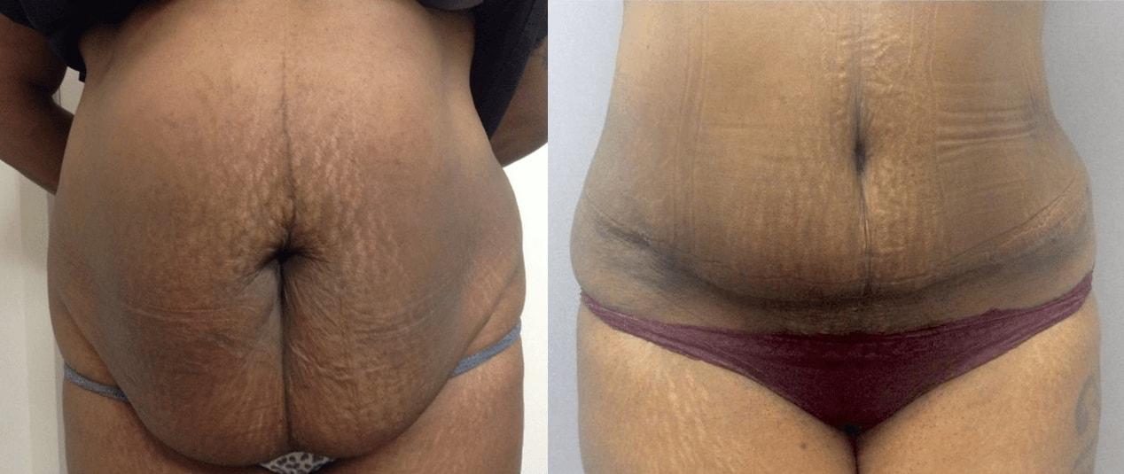 eSSe Plastic Surgery tummy tuck result — Fort Lauderdale, FL