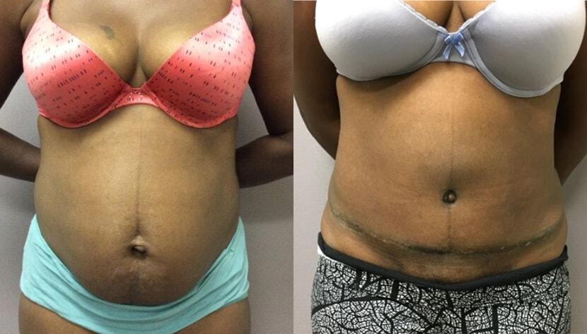 eSSe Plastic Surgery tummy tuck result — Fort Lauderdale, FL