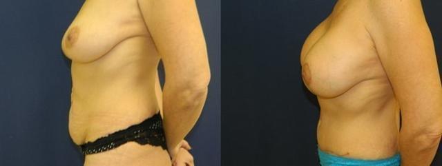 Mommy Makeover result at eSSe Plastic Surgery in Fort Lauderdale, FL