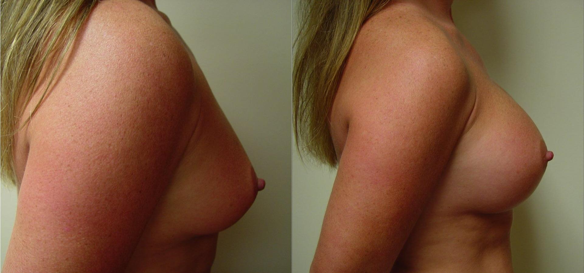 eSSe Plastic Surgery breast augmentation result — Fort Lauderdale, FL