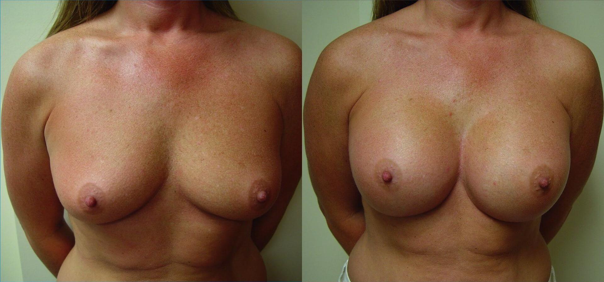eSSe Plastic Surgery breast augmentation result — Fort Lauderdale, FL