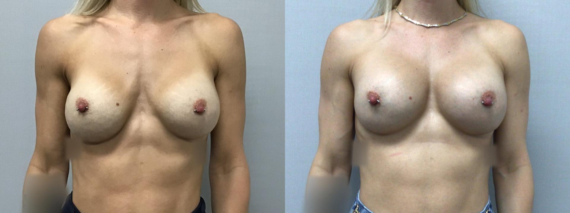 eSSe Plastic Surgery breast augmentation result — Fort Lauderdale, FL