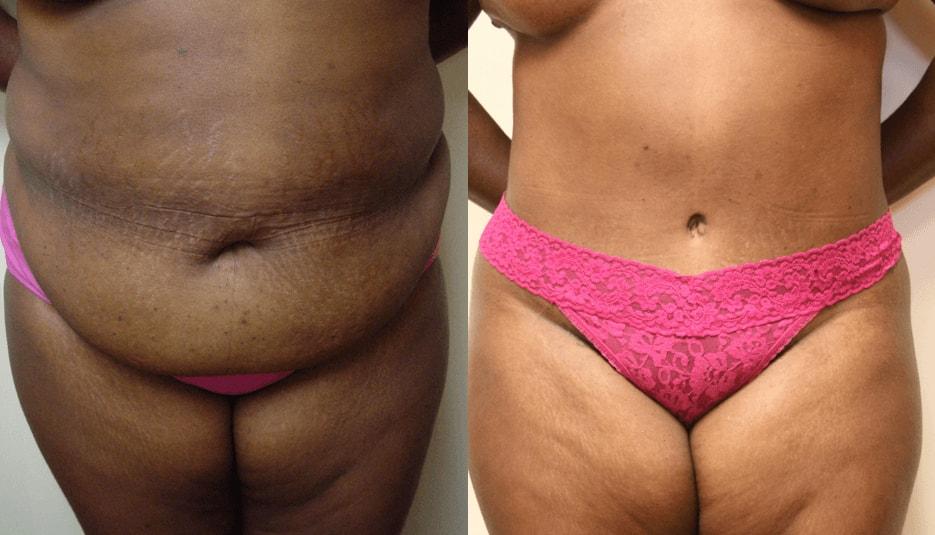 eSSe Plastic Surgery tummy tuck result — Fort Lauderdale, FL