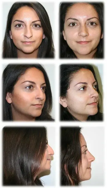 Rhinoplasty result at Thomassen Plastic Surgery in Fort Lauderdale, FL