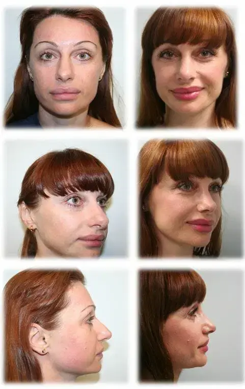 Rhinoplasty result at Thomassen Plastic Surgery in Fort Lauderdale, FL