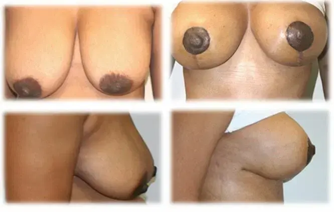 Thomassen Plastic Surgery breast lift result — Fort Lauderdale, FL