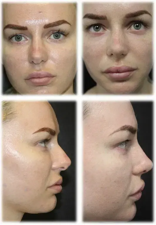 Rhinoplasty result at Thomassen Plastic Surgery in Fort Lauderdale, FL