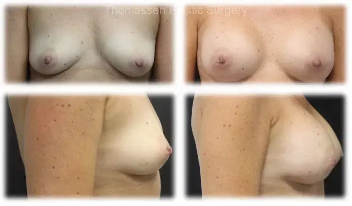 Thomassen Plastic Surgery breast augmentation result — Fort Lauderdale, FL
