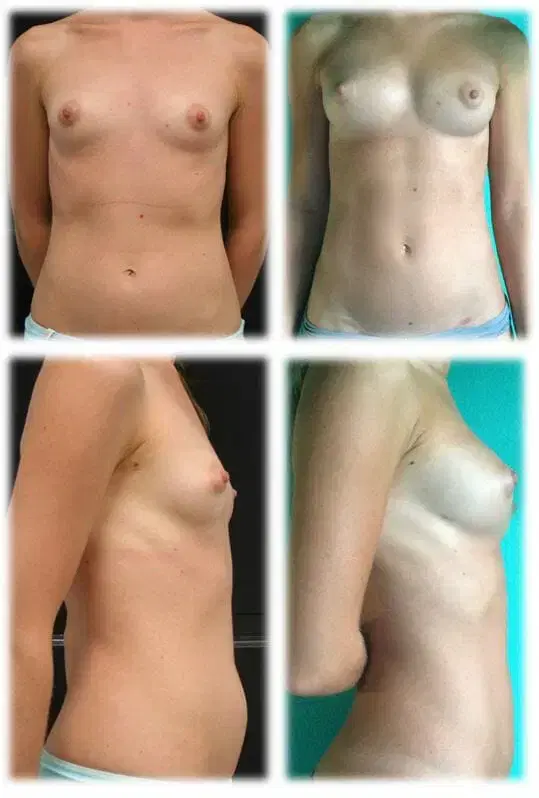 Mommy Makeover result at Thomassen Plastic Surgery in Fort Lauderdale, FL