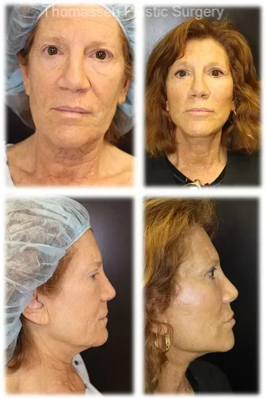Thomassen Plastic Surgery facelift result — Fort Lauderdale, FL