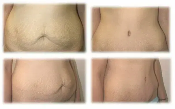 Mini Tummy Tuck result at Thomassen Plastic Surgery in Fort Lauderdale, FL