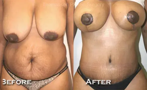 Mommy Makeover result at Thomassen Plastic Surgery in Fort Lauderdale, FL