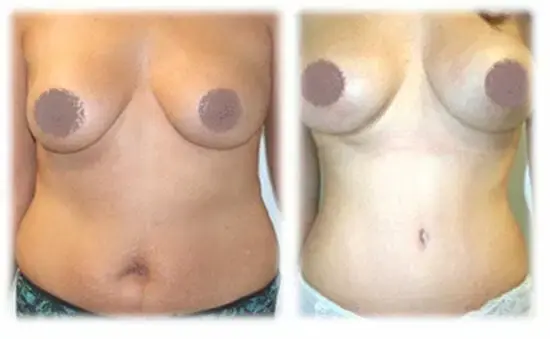 Mommy Makeover result at Thomassen Plastic Surgery in Fort Lauderdale, FL