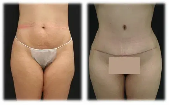 Mini Tummy Tuck result at Thomassen Plastic Surgery in Fort Lauderdale, FL