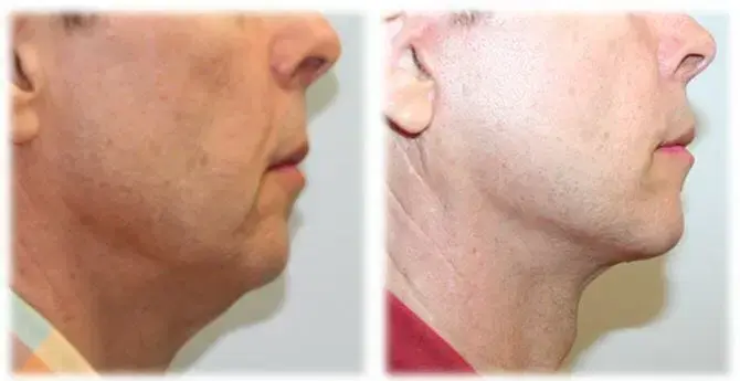 Thomassen Plastic Surgery facelift result — Fort Lauderdale, FL