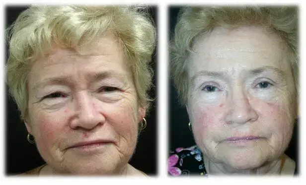 Blepharoplasty result at Thomassen Plastic Surgery in Fort Lauderdale, FL