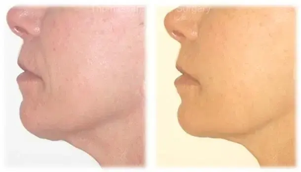 Mini Facelift result at Thomassen Plastic Surgery in Fort Lauderdale, FL