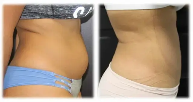 Liposuction result at Thomassen Plastic Surgery in Fort Lauderdale, FL
