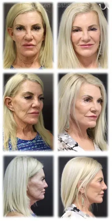 Mini Facelift result at Thomassen Plastic Surgery in Fort Lauderdale, FL