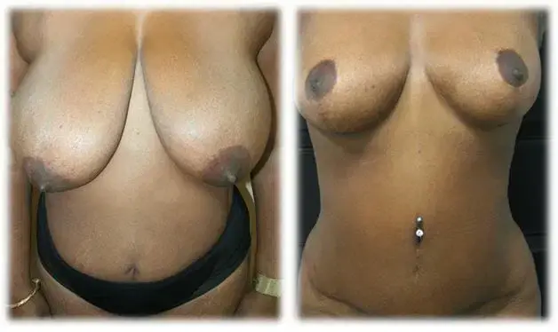Mommy Makeover result at Thomassen Plastic Surgery in Fort Lauderdale, FL
