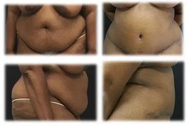 Mini Tummy Tuck result at Thomassen Plastic Surgery in Fort Lauderdale, FL
