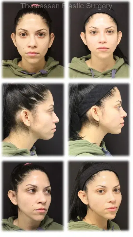 Rhinoplasty result at Thomassen Plastic Surgery in Fort Lauderdale, FL