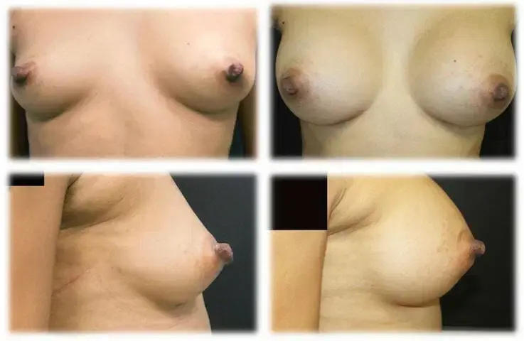 Thomassen Plastic Surgery breast augmentation result — Fort Lauderdale, FL