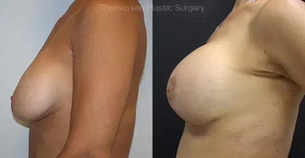 Thomassen Plastic Surgery breast lift result — Fort Lauderdale, FL