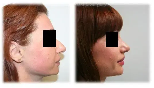 Rhinoplasty result at Thomassen Plastic Surgery in Fort Lauderdale, FL