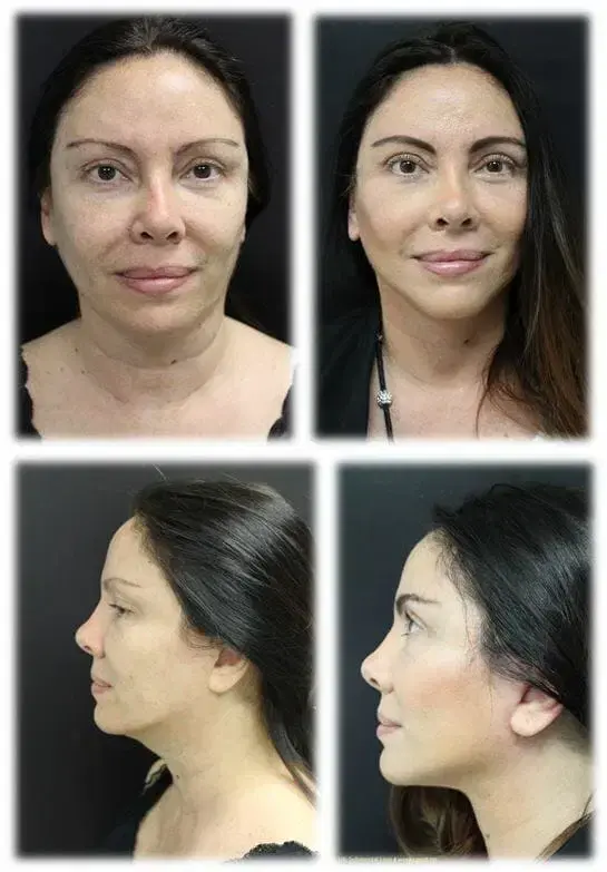 Mini Facelift result at Thomassen Plastic Surgery in Fort Lauderdale, FL