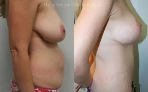 Mommy Makeover result at Thomassen Plastic Surgery in Fort Lauderdale, FL