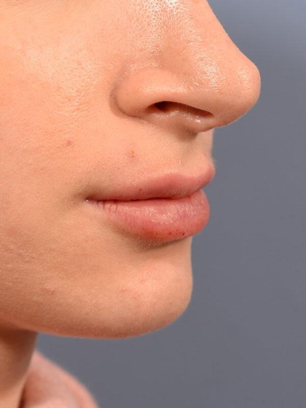 Yirae Ort MD Facial Aesthetic Surgery lip filler after — Bellevue, WA
