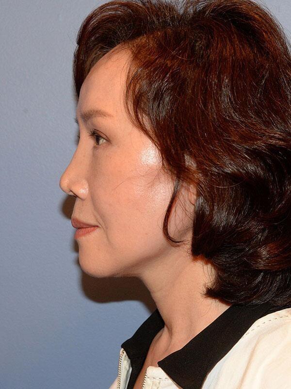 Deep Plane Facelift after at Yirae Ort MD Facial Aesthetic Surgery in Bellevue, WA