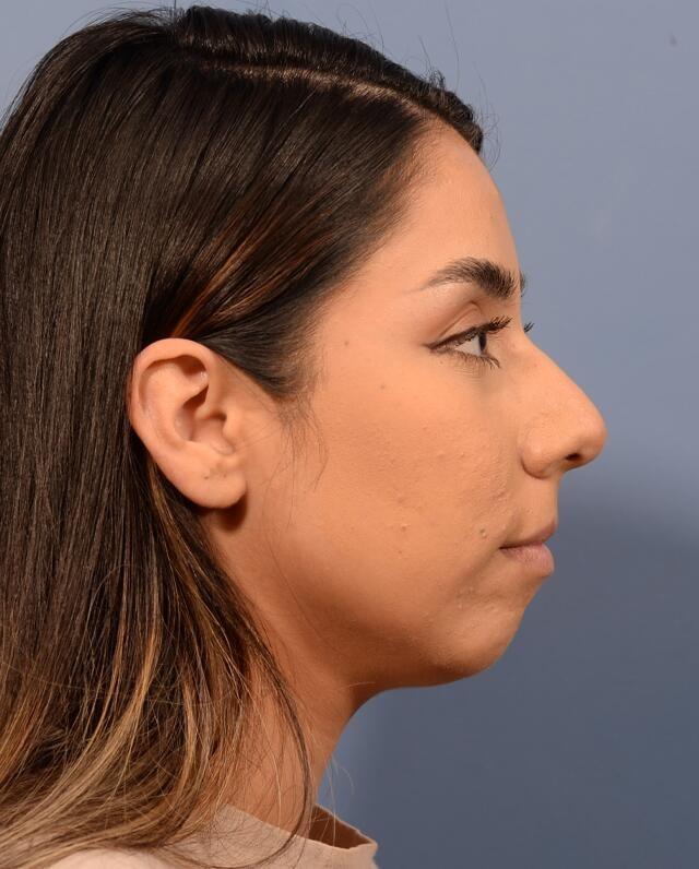 Rhinoplasty before at Yirae Ort MD Facial Aesthetic Surgery in Bellevue, WA