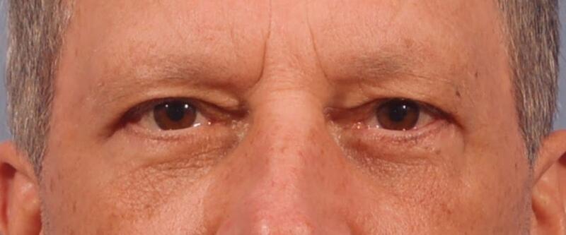 Yirae Ort MD Facial Aesthetic Surgery result — Bellevue, WA