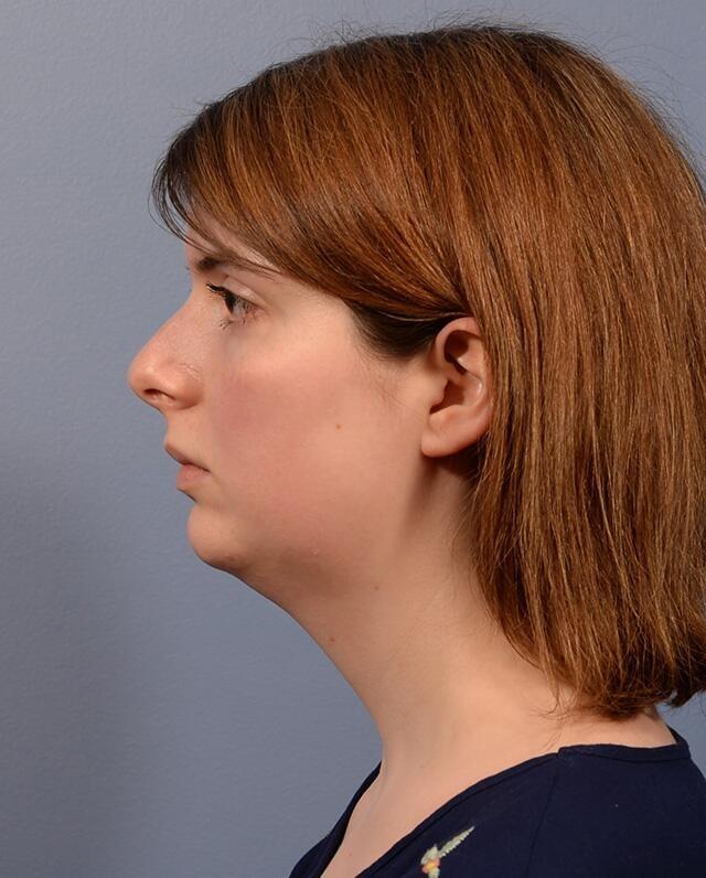 Neck Lift before at Yirae Ort MD Facial Aesthetic Surgery in Bellevue, WA
