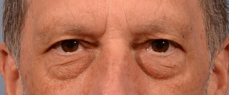 Yirae Ort MD Facial Aesthetic Surgery result — Bellevue, WA