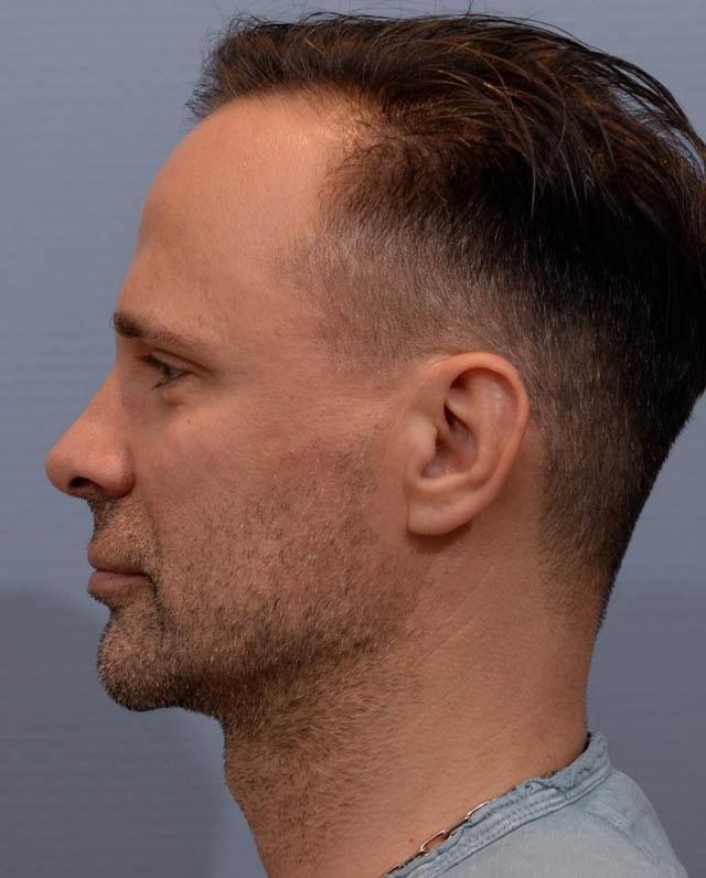 Yirae Ort MD Facial Aesthetic Surgery chin implant after — Bellevue, WA