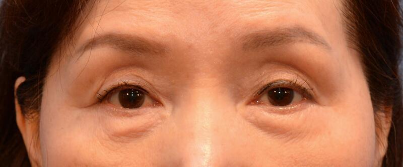 Yirae Ort MD Facial Aesthetic Surgery result — Bellevue, WA