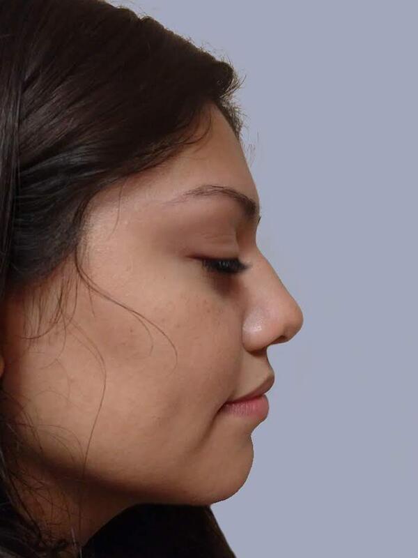Rhinoplasty before at Yirae Ort MD Facial Aesthetic Surgery in Bellevue, WA