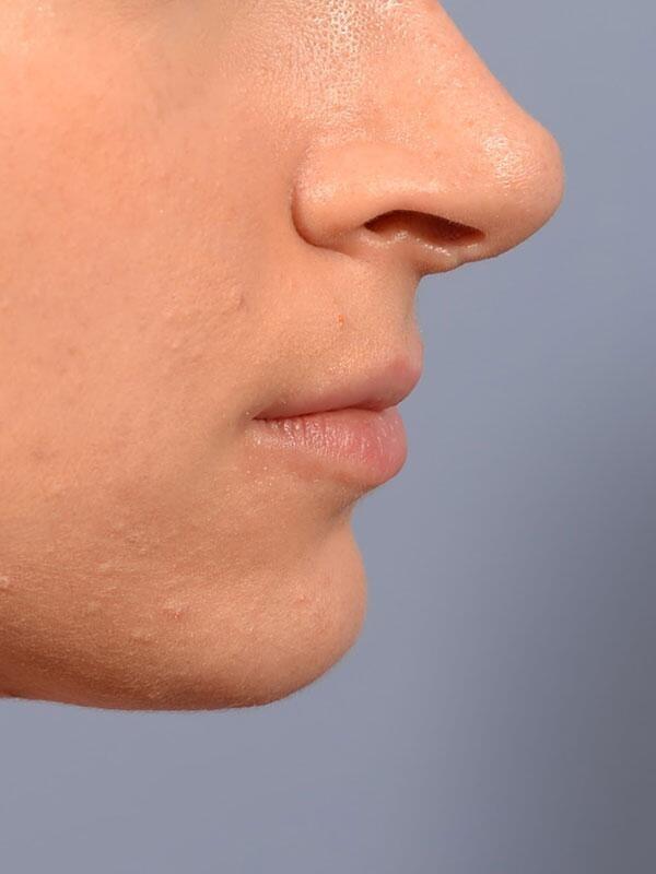 Lip Filler before at Yirae Ort MD Facial Aesthetic Surgery in Bellevue, WA