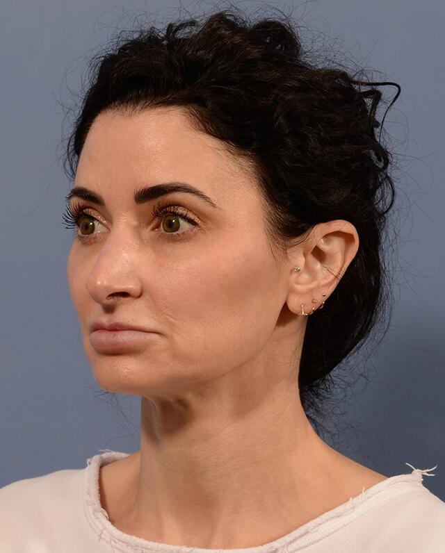Neck Lift before at Yirae Ort MD Facial Aesthetic Surgery in Bellevue, WA