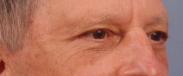 Blepharoplasty after at Yirae Ort MD Facial Aesthetic Surgery in Bellevue, WA