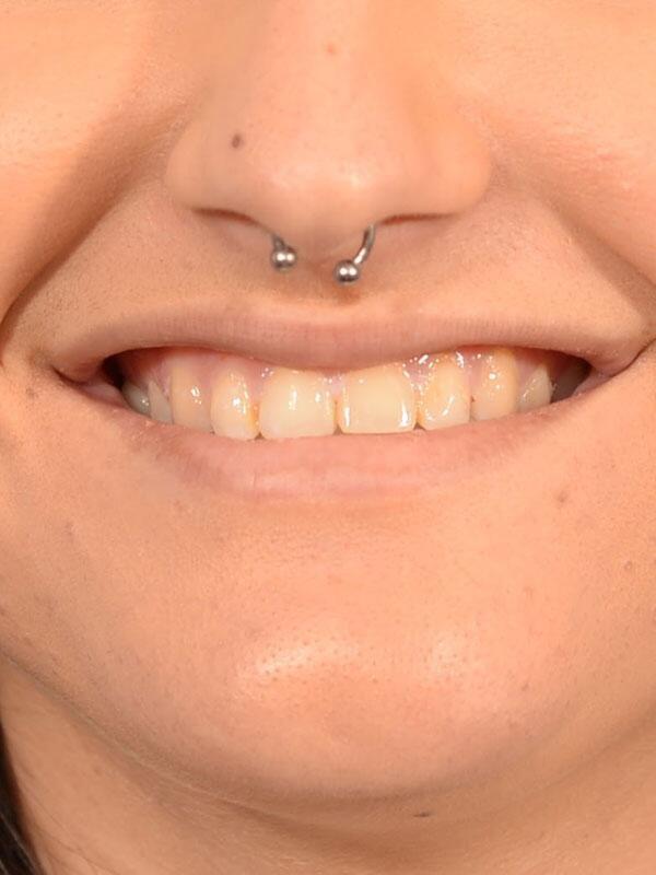 Lip Filler before at Yirae Ort MD Facial Aesthetic Surgery in Bellevue, WA